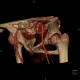 Dysplasia of femoral head: CT - Computed tomography